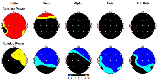 Neurofeedback