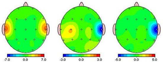 Neurofeedback